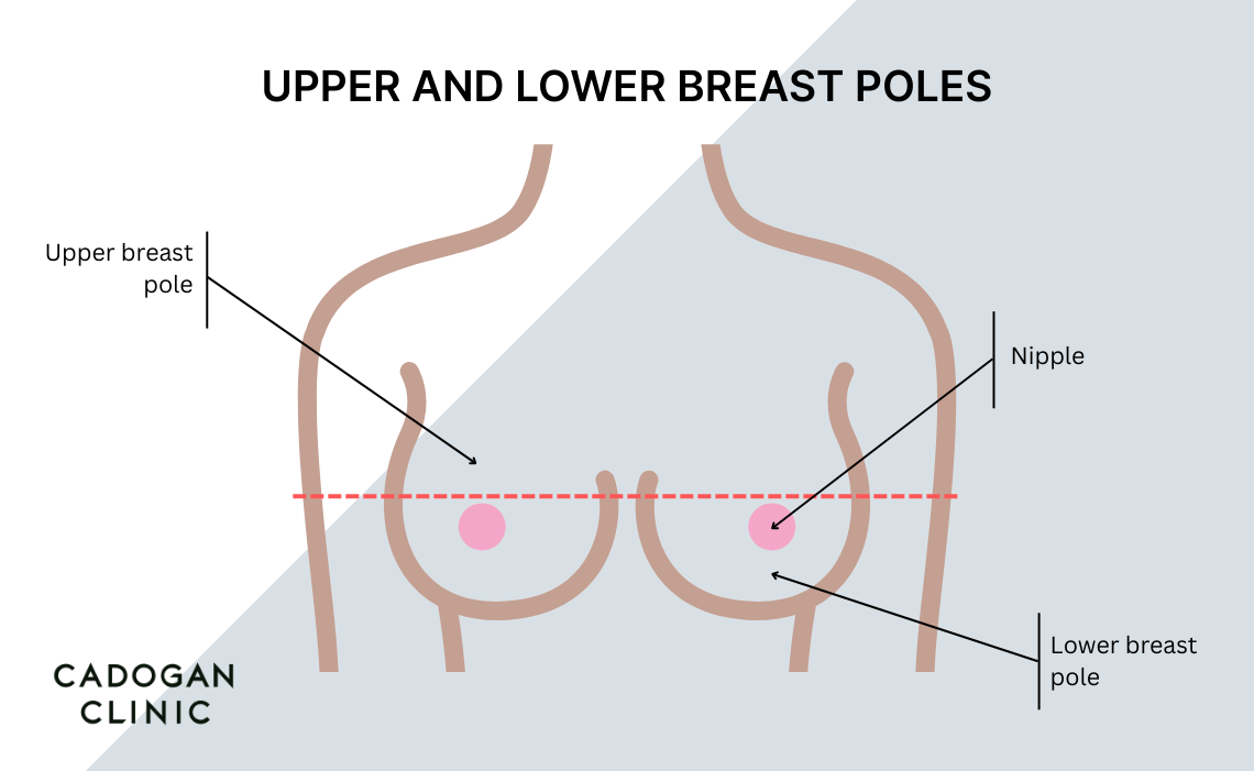 An infographic showing upper and lower poles of the breasts